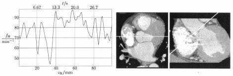 900 IEEE TRANSACTIONS ON MEDICAL IMAGING, VOL. 19, NO. 9, SEPTEMBER 2000 (a) (b) (c) Fig. 11. Patient with strongly varying heart rate.