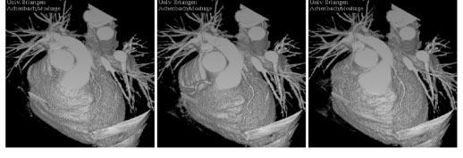 SSD of the complete heart at three different reconstruction phases c. The fast-moving right coronary artery is only depicted well in the second image, which has been centered at diastole.