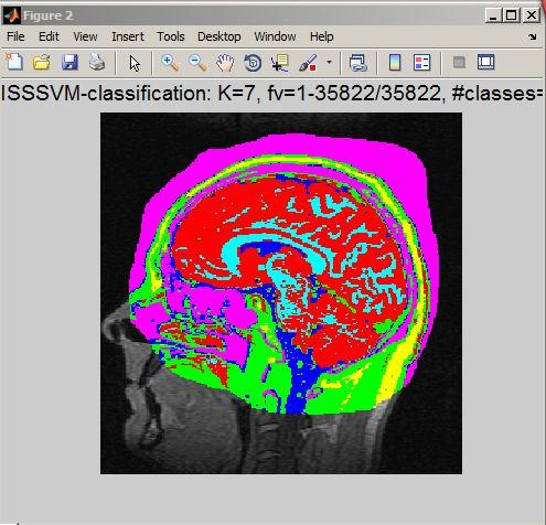 Figure 6. Mapping of Classified Tissues on Brain Map Figure 7. Coronal View of 3D 