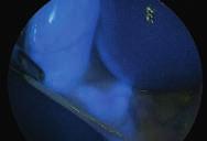 , for colon anastomoses, esophagus anastomoses and gastric bypass anastomoses NIR/ICG fluorescence imaging
