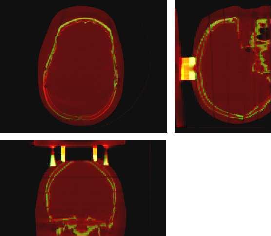 9: Alignment of the CT (green) and CBCT (red) volumes.