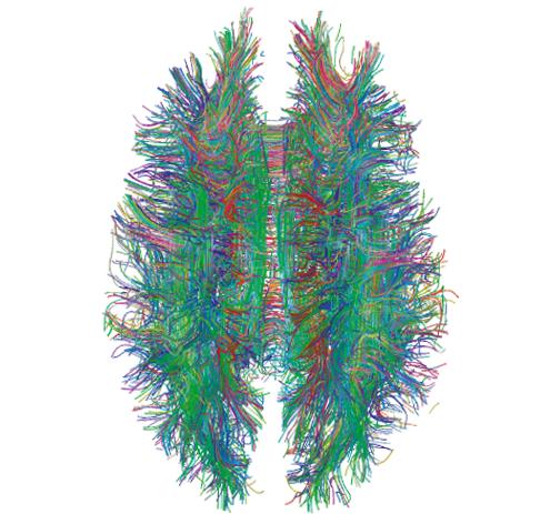 Diffusion Weighted MRI Diffusion MRI was born to observe the diffusion of water molecules in soft tissues.