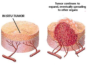 supply of new microscopic blood vessels cancerous tumors