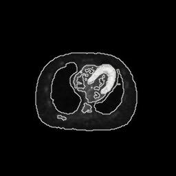 function (range=100); (d) Slice of a simulated body PET scan (luminosity and contrast have been edited); (e) Slice of the simulated PET 3D image segmented using the contrast criterion with the