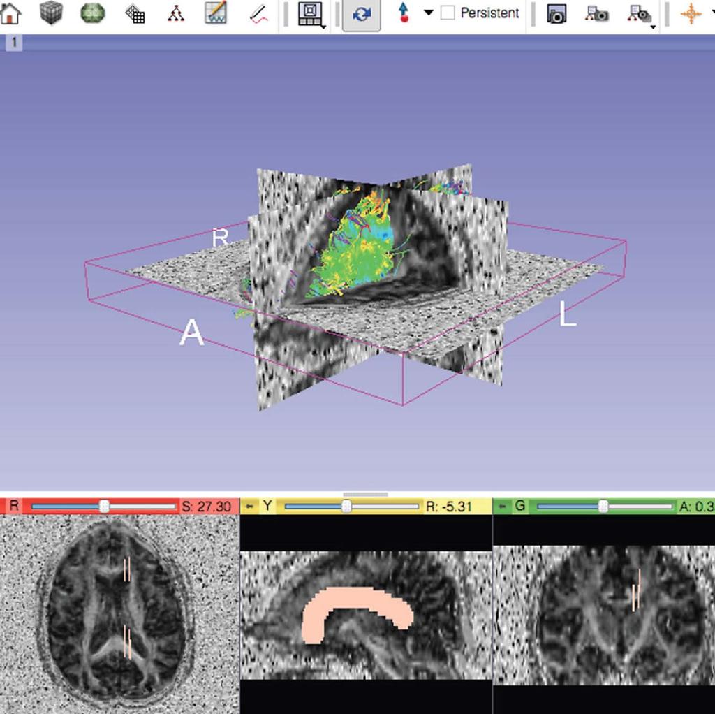 quadratic meshes. MRI data was obtained from the BRAINIX and CEREBRIX open source datasets provided by OSIRIX (http:// www.osirix-viewer.com/datasets/).