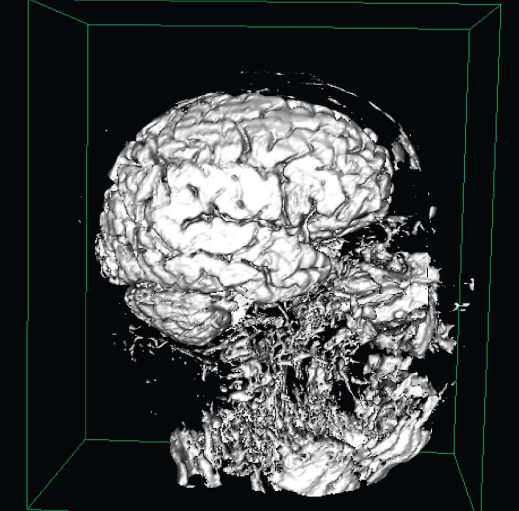 Brain and tumor displayed as volumes.