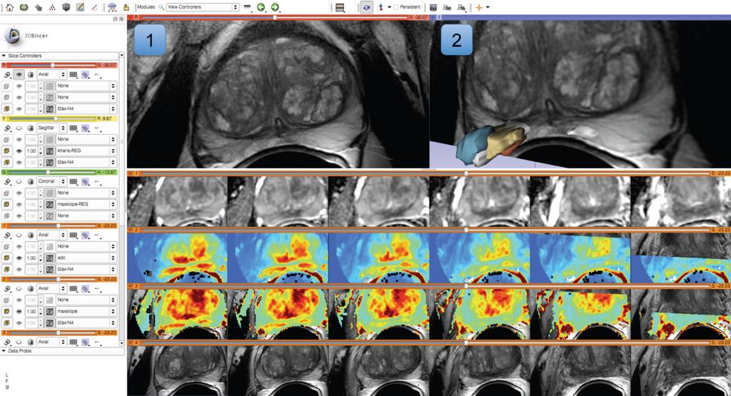 Fedorov et al. Page 26 Figure 4. Visualization capabilities and Slicer user interface are utilized for exploration of the multiparametric MRI of the prostate.