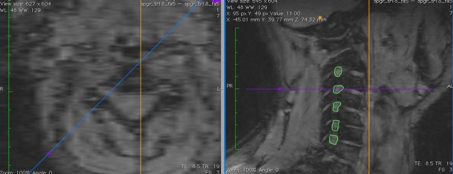 Comparison with Volumetric Data Unlike the 2D fast spin echo images, one is only able to visualize either the left or the right side of the foramen, not both.