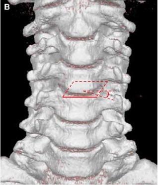 Axial, T2-weighted Image: Cervical Foramen is directed at