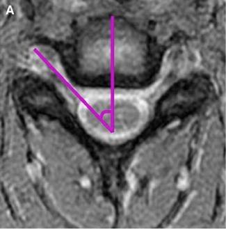 3D reconstructive CT Image shows that the cervical