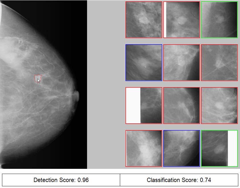 Algorithms 2009, 2 833 Figure 2: Example of applying a CAD scheme using CBIR approach to detect and classify a suspicious breast mass region.