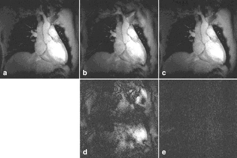 1074 Heidemann et al. FIG. 8. Cardiac imaging with VD-AUTO-SMASH using a four-element array coil for different acquisition schemes.