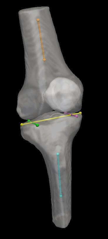 Metrics (3D) a) Static Alignment (SA) b) Medial Tibal Slope (MTS) c) Lateral Tibial Slope (LTS) d) Coronal Tibial Slope (CTS) Based on 10