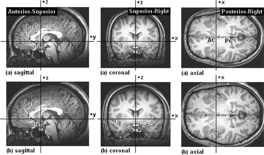 GHOLIPOUR et al.: BRAIN FUNCTIONAL LOCALIZATION: A SURVEY OF IMAGE REGISTRATION TECHNIQUES 429 are considered in Section IV-D.