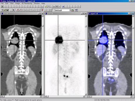 5.15c: Fused Image from CT and PET Left: CT image. Middle: PET image.
