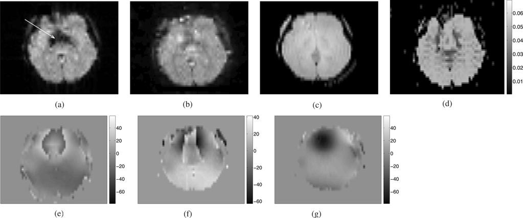 NGUYEN et al.: JOINT ESTIMATION AND CORRECTION OF GEOMETRIC DISTORTIONS FOR EPI FUNCTIONAL MRI 431 Fig. 7. Experimental results with the first subject.