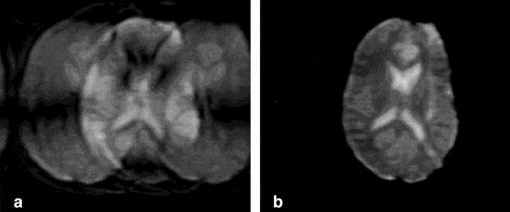 Referenceless Interleaved EPI 93 FIG. 8. Two-shot axial echo-planar image of a brain, (a) before, and (b) after compensation blip correction.