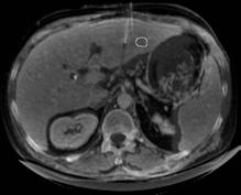 The patient was a poor surgical candidate due to other co-morbidities and underwent RFA under CT guidance. (a) The tumor margin can be clearly seen on the pre-procedural MRI.