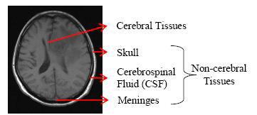 accuracy and flexibility. Detailed process flow of the proposed method is shown in Figure-1. Figure-2. Magnetic resonance image showing anatomy of human brain. B.