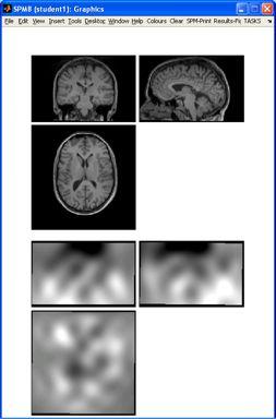 Spatial Preprocessing fmri tie-series Anatoical MRI TPMs Input Output Segentation