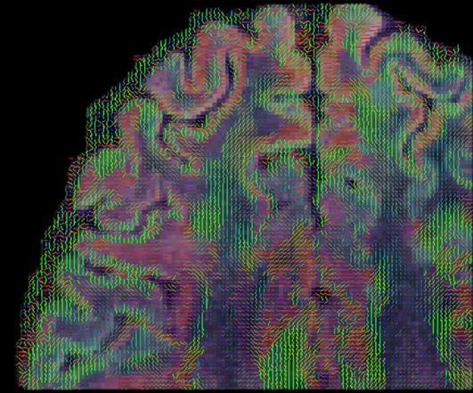 MRI RECONSTRUCTION OpenACC Accelerates Advanced MRI Reconstruction Model CHALLENGE Produce detailed and accurate brain images by applying computationally intensive algorithms to MRI data Within short
