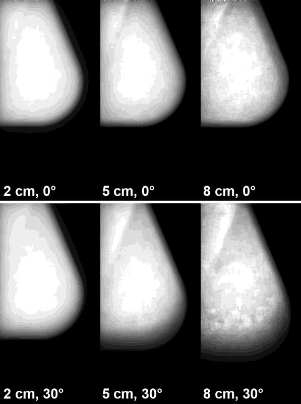 (bottom) view breast showing the absence of the