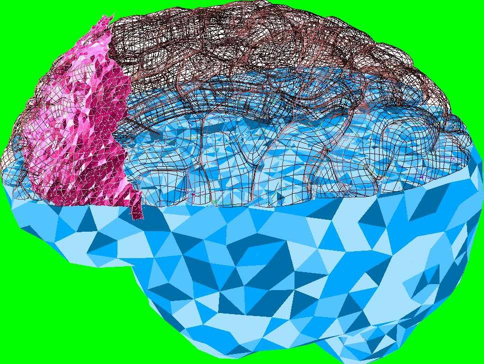 Fig.6: 3D view of the mechanical model of the brain (in blue, only cut for visualization purpose). In pink, the mesh corresponding to intra-operative data.