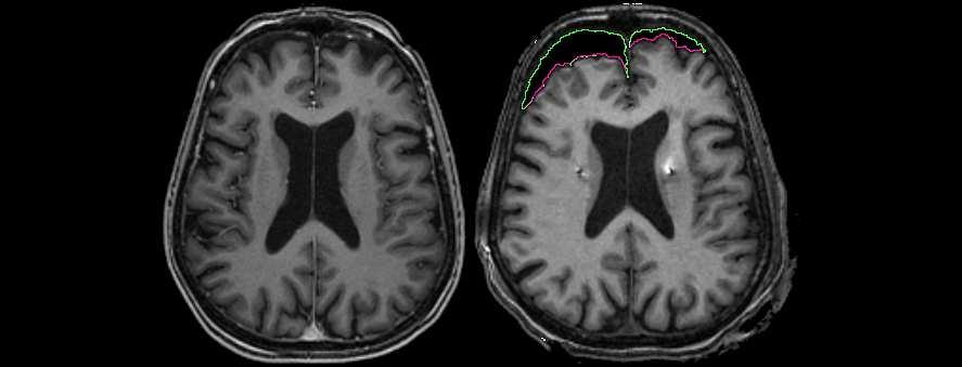 Fig. 1: Pre-operative (left) MR image without brain shift, and post-operative (right) MRI showing asymmetric brain shift.