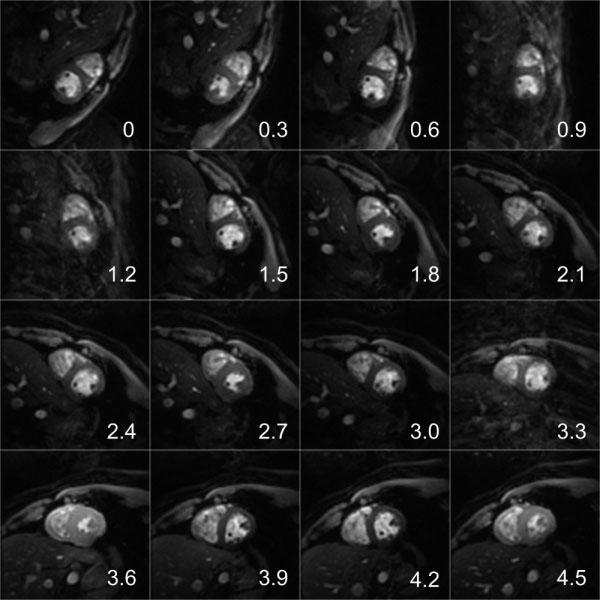 EPI Artifact Correction for Real-Time MRI 243 Table 1 GSR from the Phantom Study (See Fig.