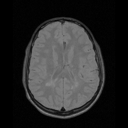 Figure 3: Segmentation of a T1-weighted brain MR image for gray matter (gray), white matter (white), and CSF (blue).