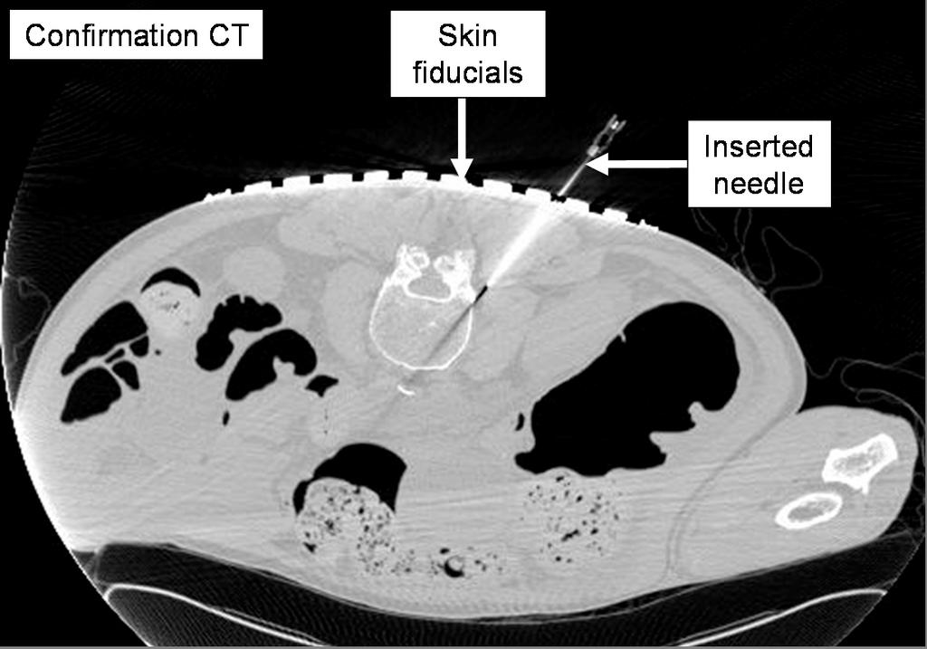 Needle Insertion in CT Scanner with Image Overlay Cadaver Studies 799 across the range of practically relevant amplitudes and distributions of noise and number of registration points.