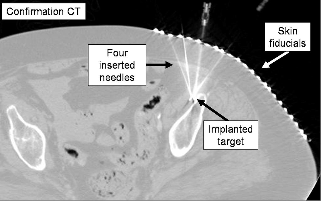 800 G. Fichtinger et al. targets, in several potential clinical applications. The accuracy of needle placement was assessed in post-insertion CT. The slice thickness was 1.0-3.