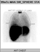 Extra hepatic shunting Lung