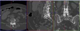 Scan 99m Tc MDP Bone SPECT/CT Focal uptake in the L4 lumbar spine: