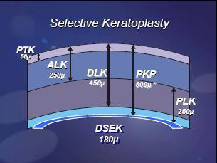 VisuMax Femtosecond System Keratoplasty range of clinical applications Surgical