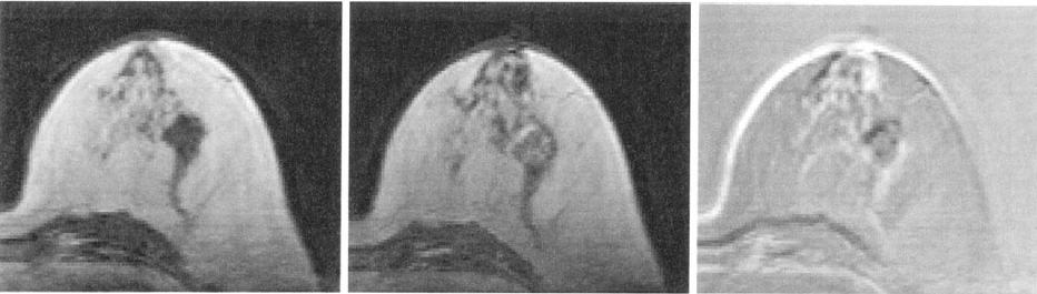 Breast MRI with contrast agent tumour detection No
