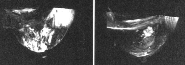 Breast MRI with contrast