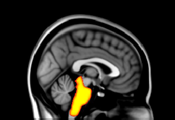 Case Study: Physiological Noise Correction Scenario: FMRI study of the brainstem Problem: High levels of pulsatility and respiratory effects in the