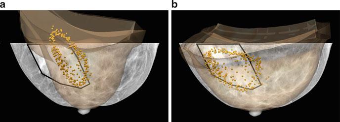 Mapping Breast Cancer Between Clinical X-Ray and MR Images 87 3 Results Each patient s breast required a significant amount of compression to match the breast thickness in the mammogram, as detailed