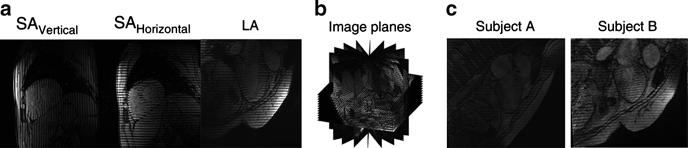 Incompressible Biventricular Model Construction and Heart Segmentation 145 2 Methods Each time frame of our tmri consists of three sets of image planes: two short axis (SA) sets and one long axis