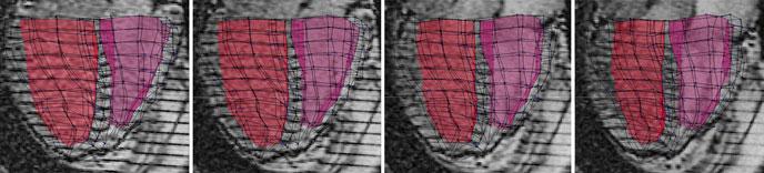 Incompressible Biventricular Model Construction and Heart Segmentation 151 DpTh region contrast to be visibly increased (Fig. 6a, second column).