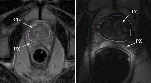 Predicting Prostate Deformation for MRI-Guided Interventions 41 this therapy have been previously described in [11].