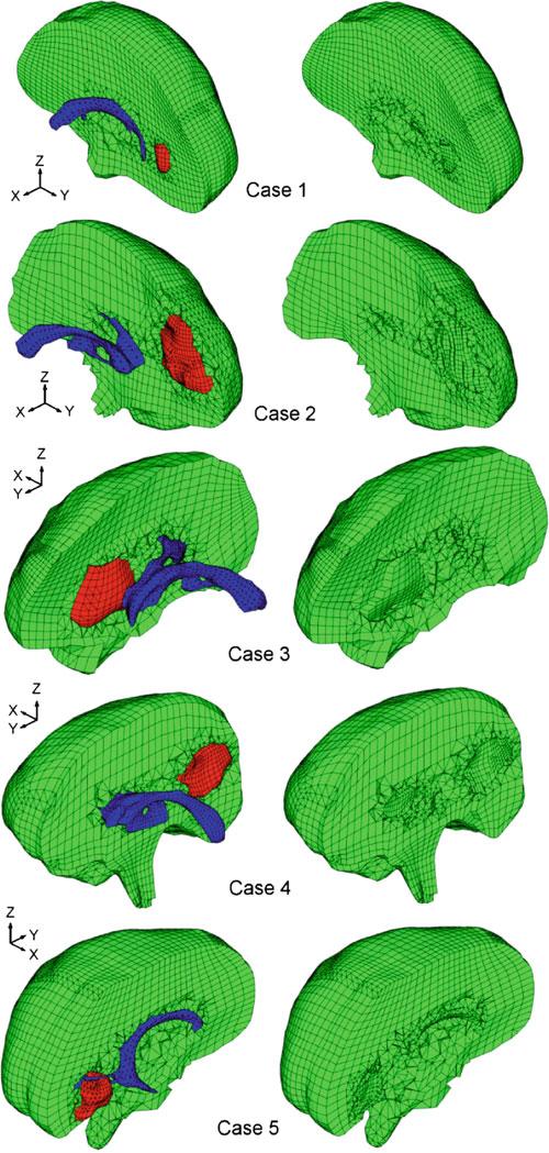 54 J. Ma et al. Fig. 2 The complete model (A, left) and homogeneous one (D, right) for the five cases of craniotomy induced brain shift analysed here.