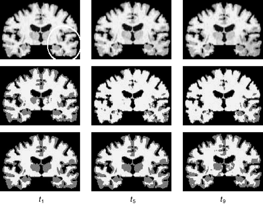 Z. Xue et al. / NeuroImage 30 (2006) 388 399 393 Fig. 3. An example of the segmentation results for simulated 4-D images with local (see the white circle) longitudinal intensity/contrast decrease.