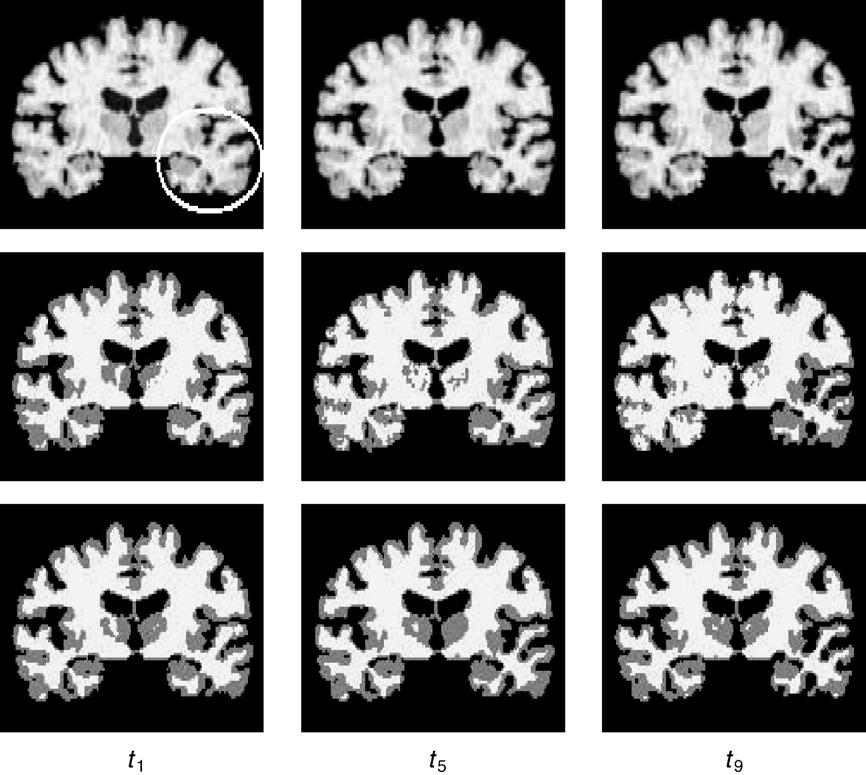 394 Z. Xue et al. / NeuroImage 30 (2006) 388 399 Fig. 6. An example of segmenting the simulated longitudinal data with local atrophy and intensity/contrast decrease.