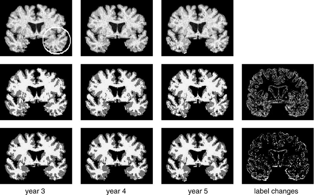 Z. Xue et al. / NeuroImage 30 (2006) 388 399 395 Fig. 9. Temporal consistency of GM and WM of different subjects. Small values indicate relatively less temporally consistent segmentation.