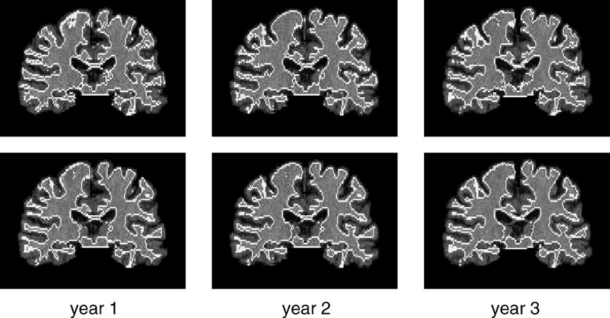 396 Z. Xue et al. / NeuroImage 30 (2006) 388 399 Fig. 11. An example of segmentation results for a series of three MR brain images.