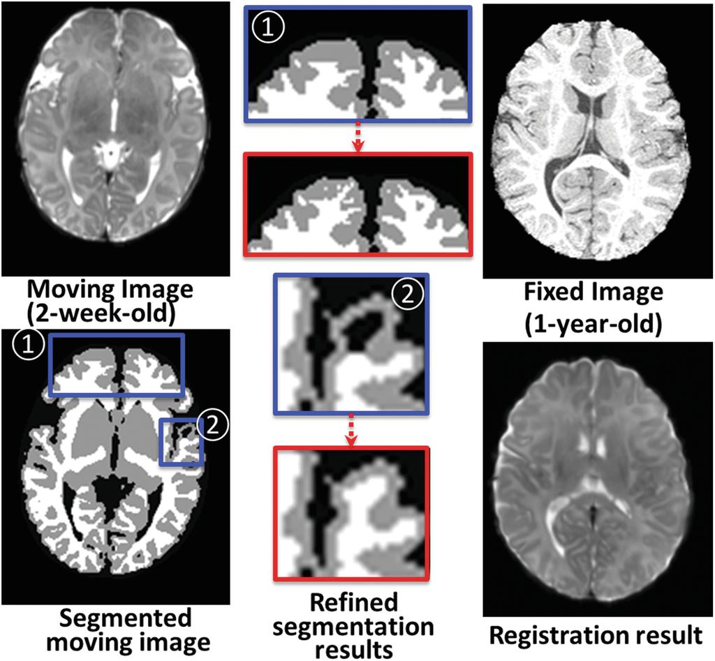 20 G. Wu et al. Fig. 2. Segmentation improvements on 2-week-old infant brain images, from results in blue boxes to the results in red boxes (Colour ﬁgure online).