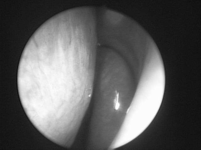 In image-guided sinus surgery, registration is performed based on fiducial points or based on the surface parameters [3].