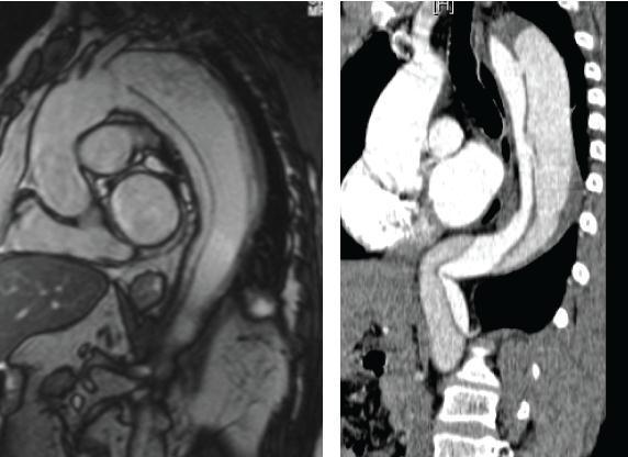Use Case Clinical view: Aorta diseases: Thoracic Aortic Aneurysms (Marfan s Syndrome) Aorta
